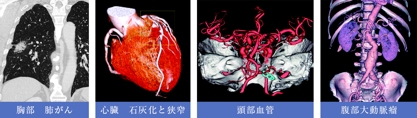 心臓、大動脈、気管支・肺などのCT画像